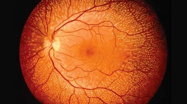 Важность обследования сетчатки глаза