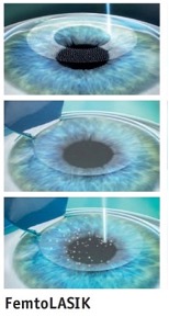 Операция на глаза по технологии FEMTO LASIK