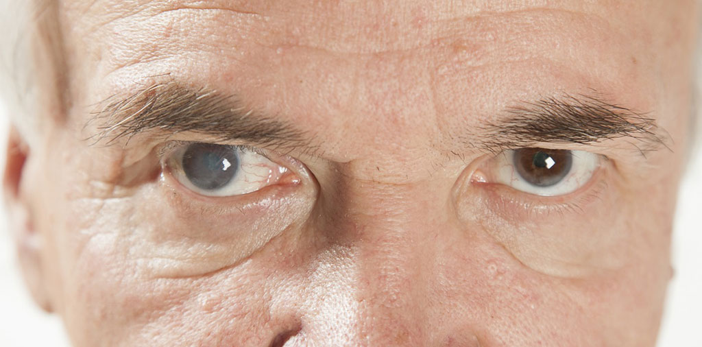 Симптомы бельма на глазу